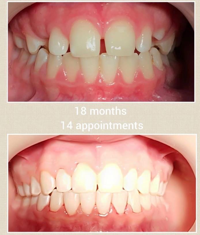 Dental treatment before and after result 2